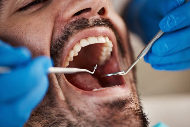 Best Emergency Wisdom Teeth Removal in Lake Mohawk, NJ