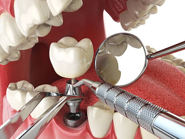 Best Emergency Wisdom Teeth Removal in Lake Mohawk, NJ